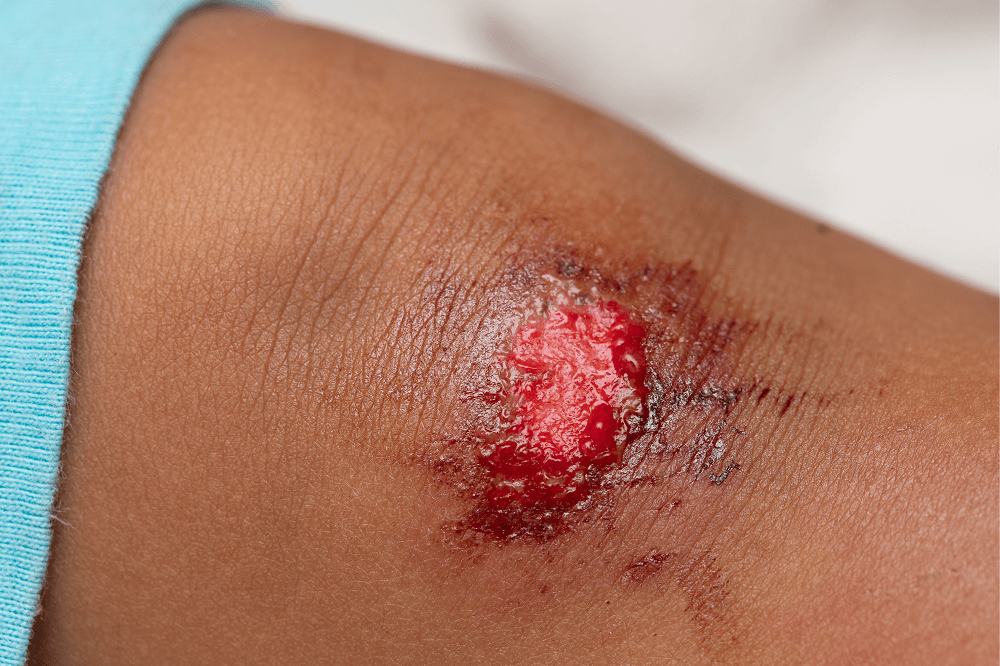 How to treat different types of cuts, grazes, and gashes - We Can