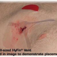 Hyfin Chest Seal 1