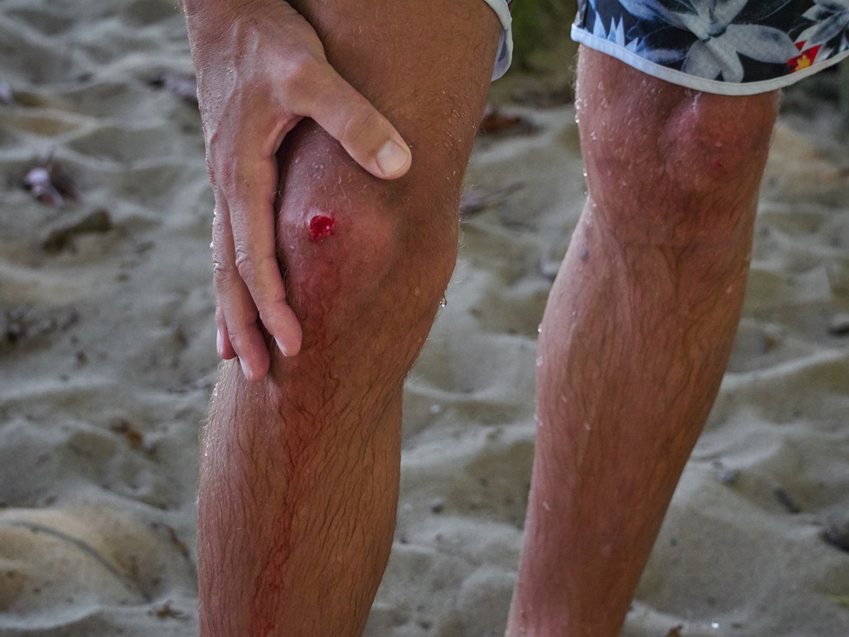 Treating surfing injuries