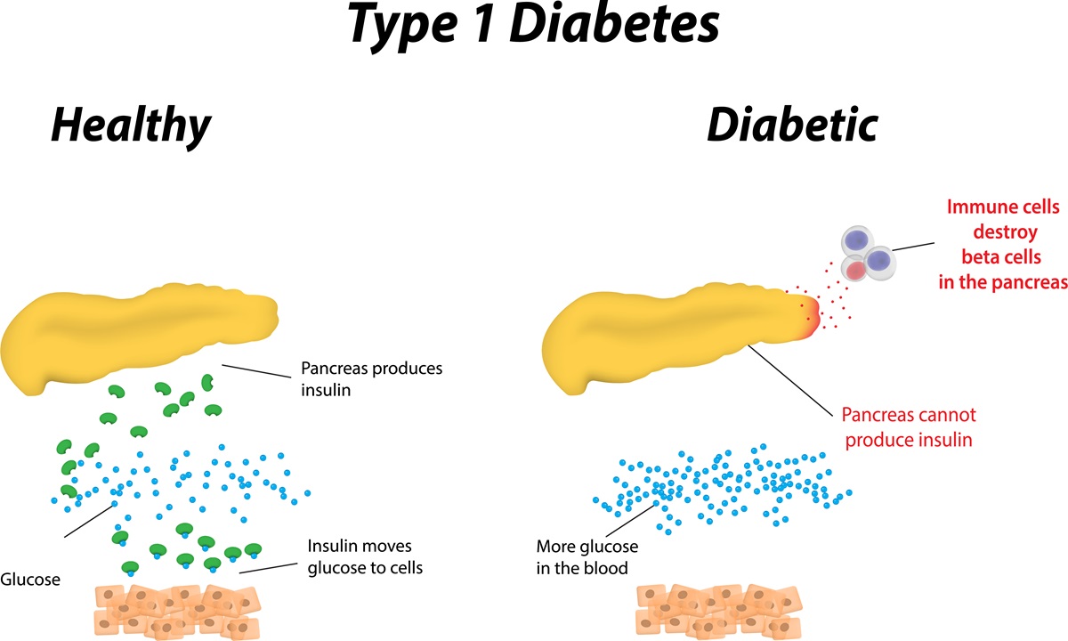 Diabetes Type 1 Cure